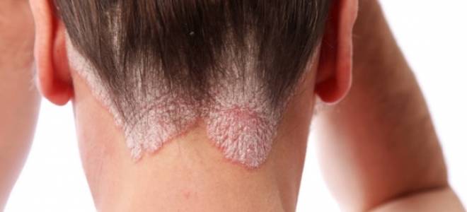 если слезает дерма