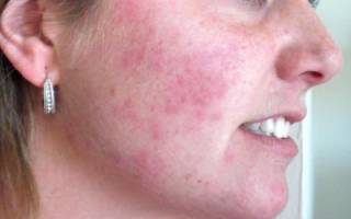 Аллергические угри на лице