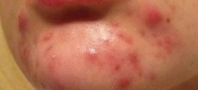 Причины появления угрей на подбородке